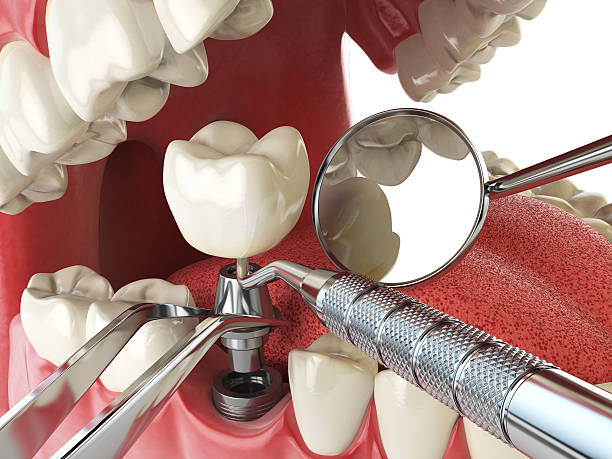 Best Emergency Dentist for Knocked-Out Tooth in Cohoes, NY